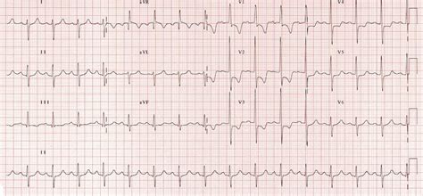 signs of right ventricular strain